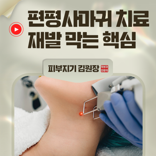 편평사마귀, 레이저로 없앴는데 왜 또 재발할까?